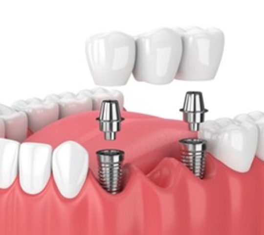 dental implants in Karimnagar | dental implants treatment in karimnagar dental implants in Karimnagar | dental implants treatment in karimnagar